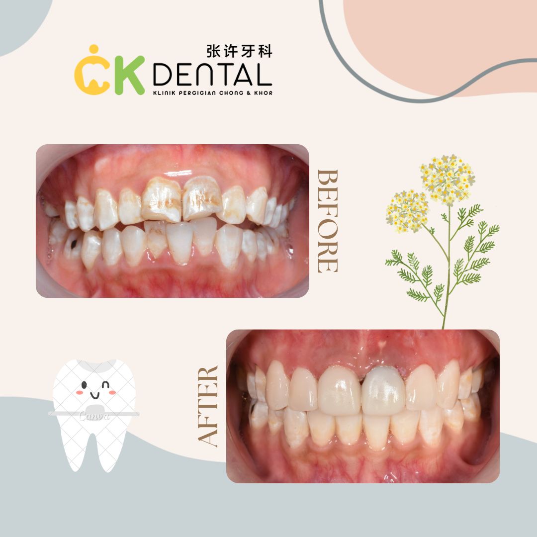 Wisdom Tooth